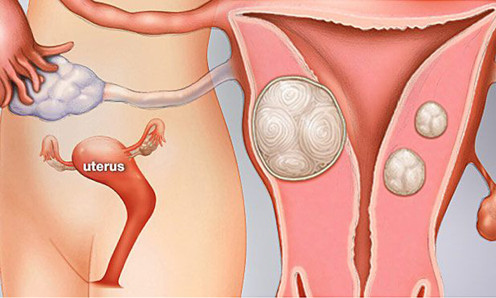 Fibroid