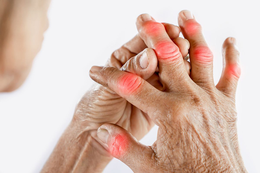 Rheumatoid Arthritis 