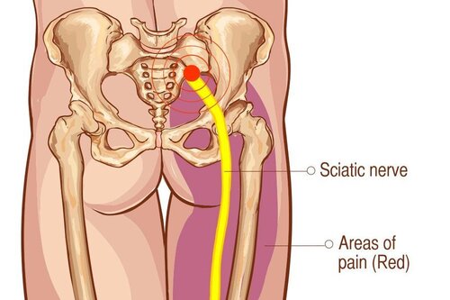 Sciatica  